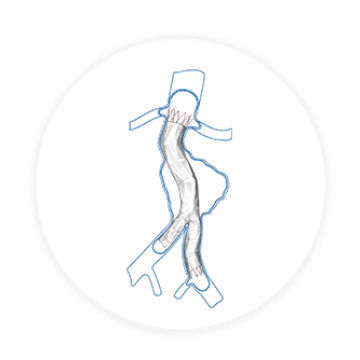 Stent-enxerto de aorta abdominal - Aegis™ - Endovastec - em nitinol / em ePTFE