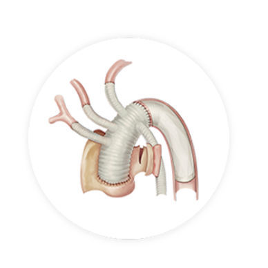 Stent-enxerto para arco aórtico - CRONUS™ - Endovastec - em cromo-cobalto / em polietileno