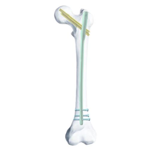 Haste intramedular para fêmur - SGG - Chongqing FWS Medical Device - em titânio
