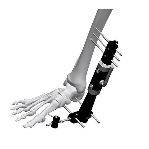 Fixador externo para tornozelo - FE8M-D050   - Chongqing FWS Medical Device - tubular