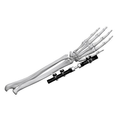 Fixador externo para punho - FE5M-D030  - Chongqing FWS Medical Device - tubular