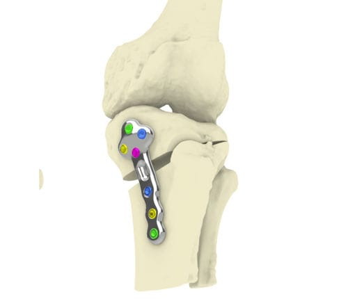 Placa de osteotomia para tíbia - TOKA - Orthoscape - bloqueada / metálica