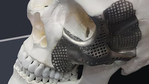 Implante orbitário sob medida - OrthoCMF - Orthoscape - não absorvível