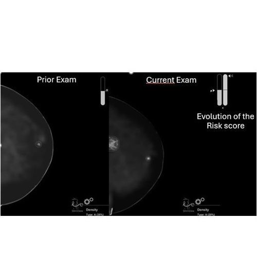 Software de diagnóstico - Breast-SlimView&reg; - Hera-MI - para rastreamento do câncer de mama / médico-hospitalar / para mamografia