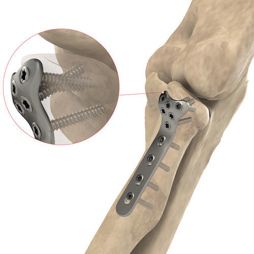 Placa de compressão óssea para cabeça do rádio - AS.E.019 - Ases Orthopedics - proximal / bloqueada / em titânio