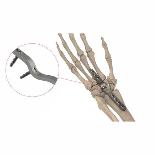 Placa de artrodese para punho - AS.W.074 - Ases Orthopedics - dorsal / bloqueada / não bloqueada