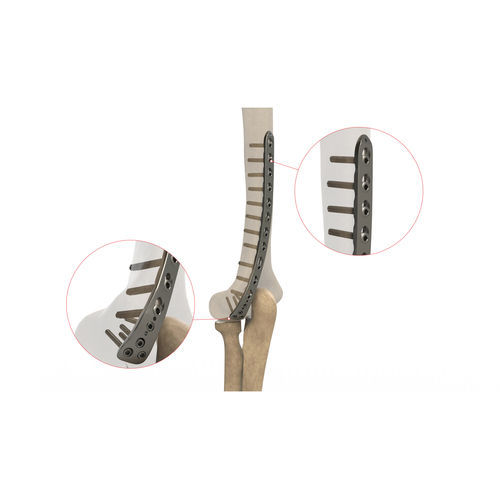 Placa de compressão óssea para úmero - Ases Orthopedics - distal / posterolateral / bloqueada