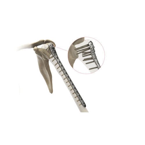 Placa de compressão óssea para úmero - Ases Orthopedics - proximal / bloqueada