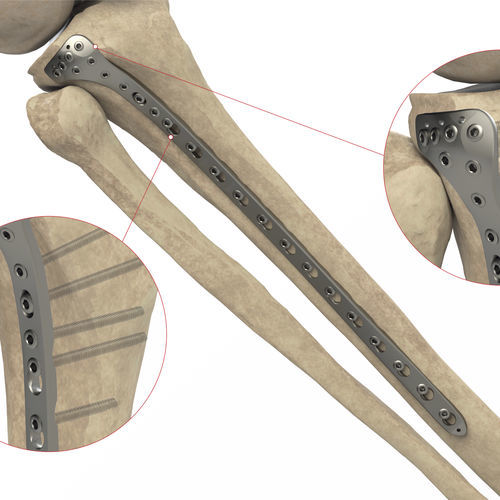 Placa de compressão óssea para tíbia - Ases Orthopedics - proximal / lateral / bloqueada