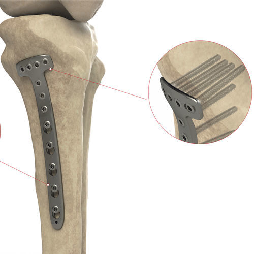 Placa de compressão óssea para tíbia - Ases Orthopedics - proximal / medial / bloqueada