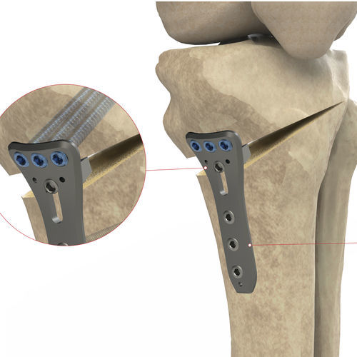 Placa de compressão óssea para tíbia - Ases Orthopedics - bloqueada