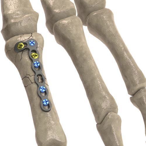 Placa de compressão óssea para falange da mão - 1T112-100242705L - Ases Orthopedics - bloqueada