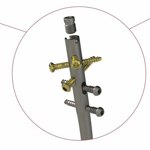 Haste intramedular para tíbia - 4T1-4011000 - Ases Orthopedics