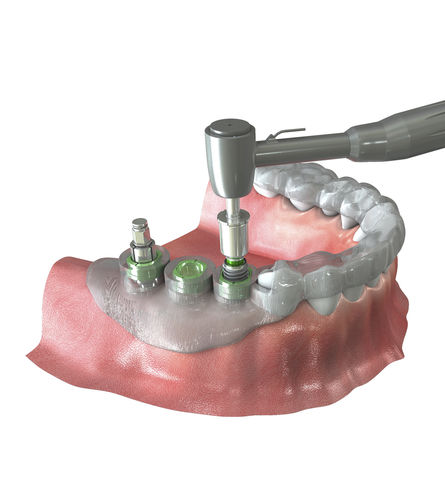 Sistema de navegação cirúrgica para cirurgia odontológica - Neo NaviGuide - Neobiotech - óptico
