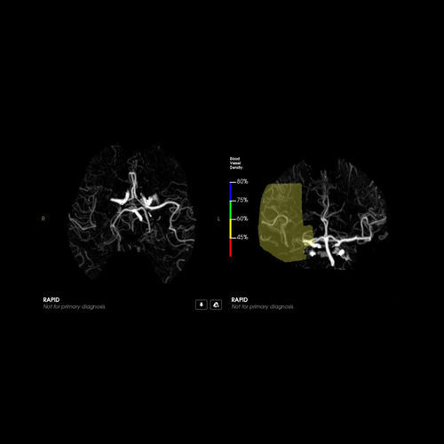 Software de tratamento - CTA - RapidAI - de captura / médico-hospitalar / para TC