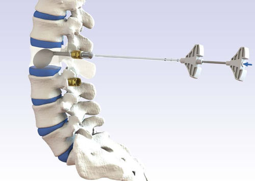 Dispositivo para reparação de fraturas vertebrais com bainha de acesso - VENUS® - HumanTech Dental - para cifoplastia percutânea