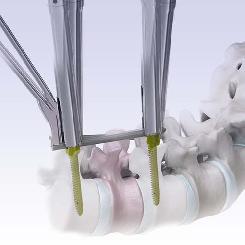 Sistema de posicionamento de parafusos pediculares minimamente invasivo - VENUS®mini 2.0 - HumanTech Dental
