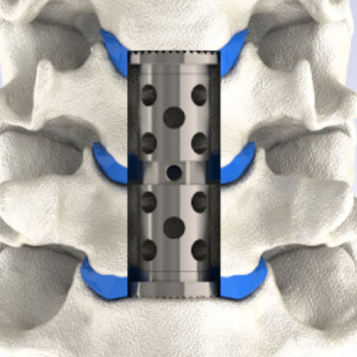 Prótese vertebral cervical - LEANDER® - HumanTech Dental - extensível