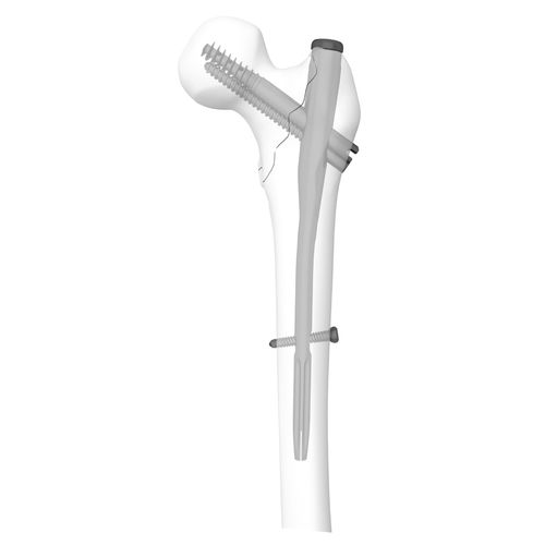 Haste intramedular para fêmur - 305030 series - Boneunion Medical - fixação proximal / para lado direito / para lado esquerdo