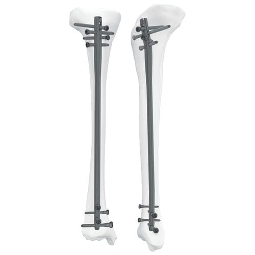 Haste intramedular para tíbia - 305050 series - Boneunion Medical - fixação proximal / fixação distal / para lado direito
