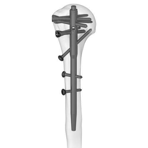 Haste intramedular para úmero - 305077 series - Boneunion Medical - fixação proximal / fixação distal / para lado direito