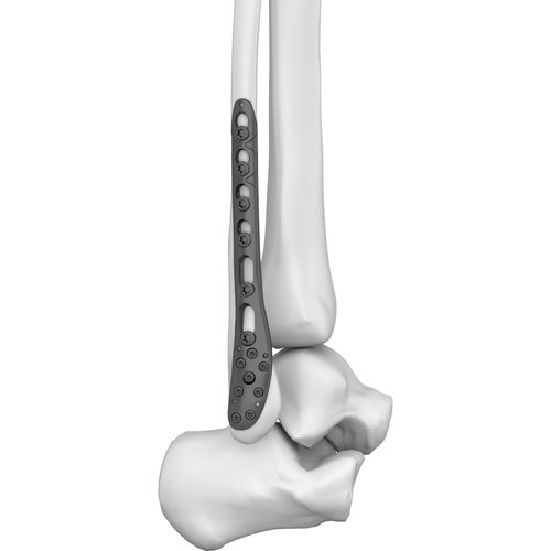 Placa de compressão óssea para fíbula - 301019 series - Boneunion Medical - distal / bloqueada / em titânio