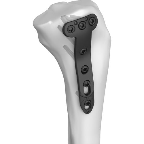 Placa de compressão óssea para tíbia - 301005 series - Boneunion Medical - proximal / medial / bloqueada