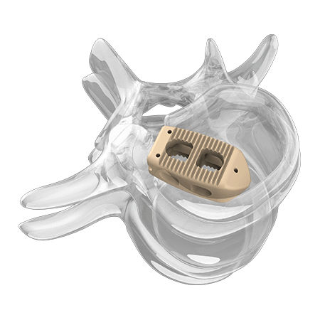 Espaçador intervertebral lombar - 4000 series - Aplus Biotechnology - via posterior / em PEEK