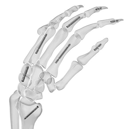 Parafuso para artrodese para carpo - Aplus Biotechnology - para falange da mão / sem cabeça