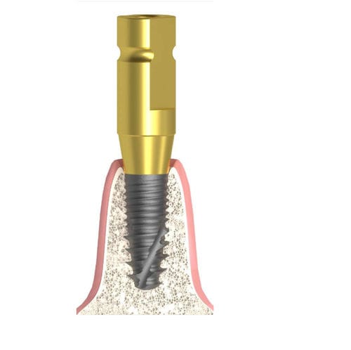 Coping de moldagem metálico - Bioplant - Bionika Medline Kft. - de parafuso / liso