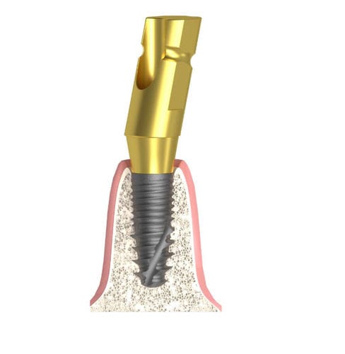 Coping de moldagem metálico - Actival - Bionika Medline Kft. - angular / de parafuso / liso