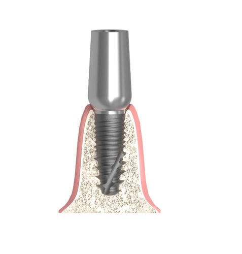 Pilar para implante cilíndrico - Actival - Bionika Medline Kft. - em titânio / interno / reto