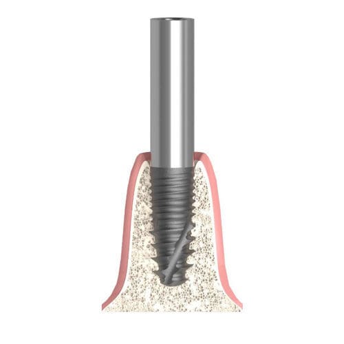 Pilar para implante cilíndrico - Actival - Bionika Medline Kft. - em titânio / interno / reto