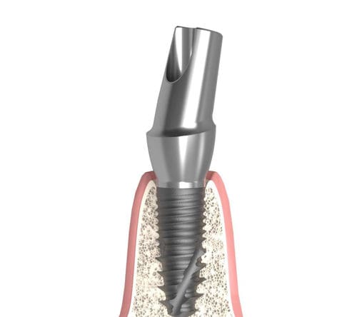 Pilar para implante cônico - Actival - Bionika Medline Kft. - em titânio / hexagonal / interno