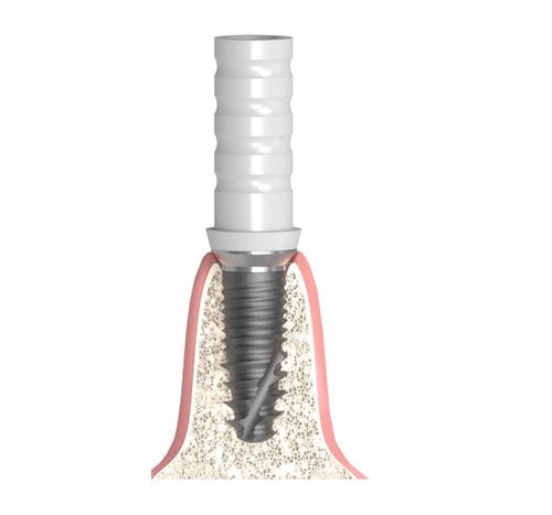 Pilar para implante cilíndrico cônico - Actival - Bionika Medline Kft. - em titânio / em material plástico / interno