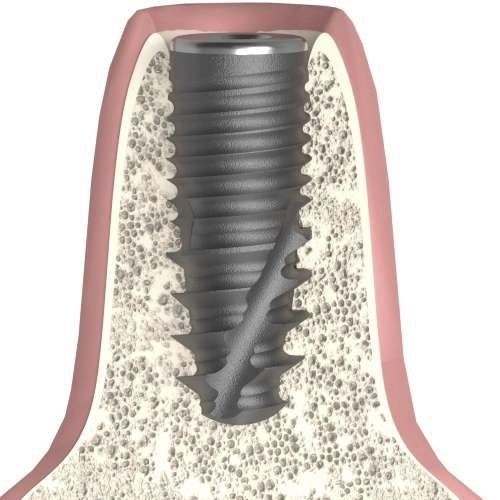 Implante dentário cilíndrico cônico - UNIFORM - Bionika Medline Kft. - em titânio / hexagonal / interno