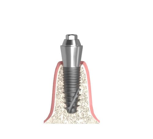 Pilar para implante cilíndrico cônico - Actival - Bionika Medline Kft. - metálico / cônico / interno