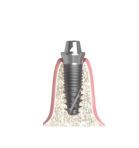 Pilar para implante cilíndrico cônico - Actival - Bionika Medline Kft. - metálico / cônico / interno