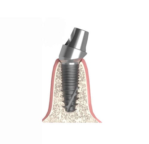 Pilar para implante cilíndrico cônico - Actival - Bionika Medline Kft. - metálico / interno / angular