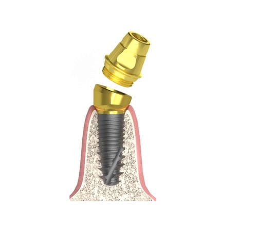 Pilar para implante cônico - Actival - Bionika Medline Kft. - em titânio / cônico / interno