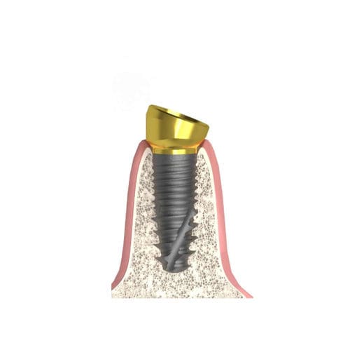 Pilar para implante cilíndrico cônico - Actival - Bionika Medline Kft. - em titânio / cônico / interno