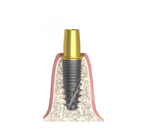 Pilar para implante cilíndrico cônico - UNIFORM DIO® UF - Bionika Medline Kft. - em titânio / interno / reto