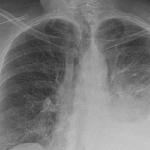 Software de análise de imagens - CXR - Carebot - médico-hospitalar / para radiologia / de peito