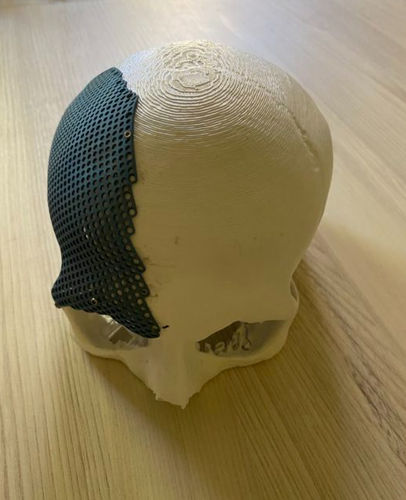 Prótese craniana sob medida - hb ortho