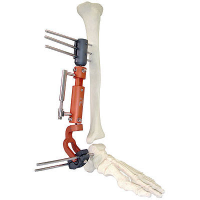 Fixador externo para tornozelo - 567 - BAUMER  - tubular
