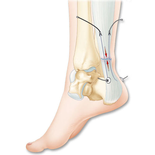 Prótese ligamentar para tendão calcâneo - Tenolig® - FH Orthopedics - sintética