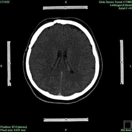 Software de planejamento - iPS - inomed Medizintechnik - de verificação / para neurocirurgia / para neurocirurgia estereotáxica