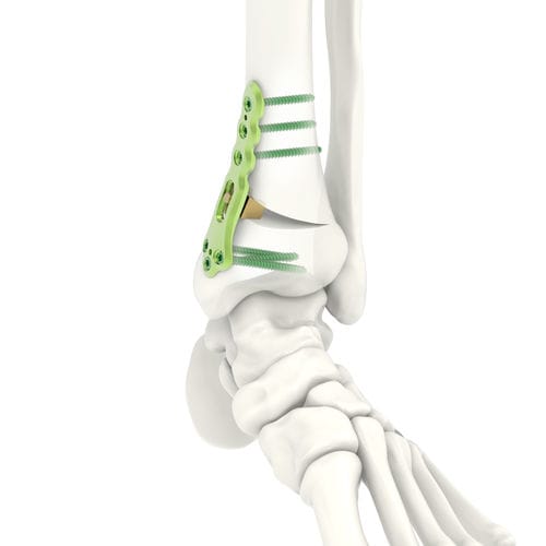 Placa de osteotomia para tíbia - ARIX 3.5 - Jeil Medical Corporation - distal / bloqueada / em titânio