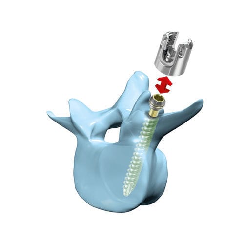 Parafuso pedicular lombar - “mediRod®”-Tri - Medicon eG - poliaxial / canulado