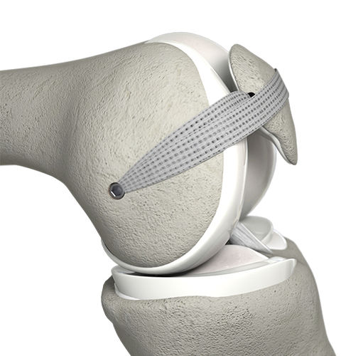 Prótese ligamentar para ligamento femoropatelar - MPFL™ - Neoligaments - sintética